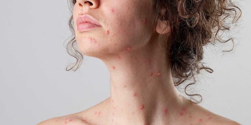 is shingles contagious