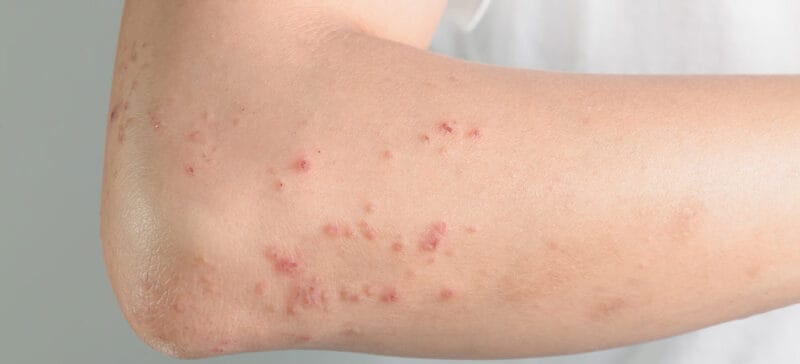 shingles common symptoms